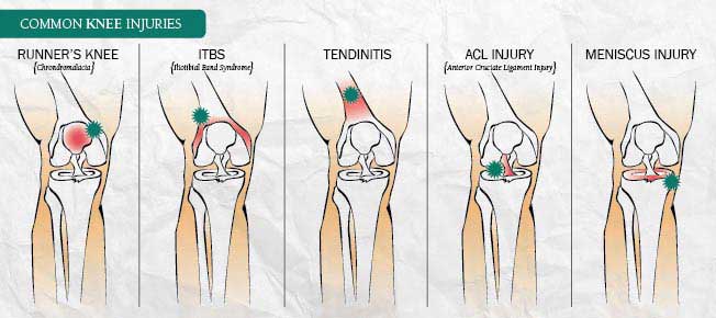 Knee Location Chart